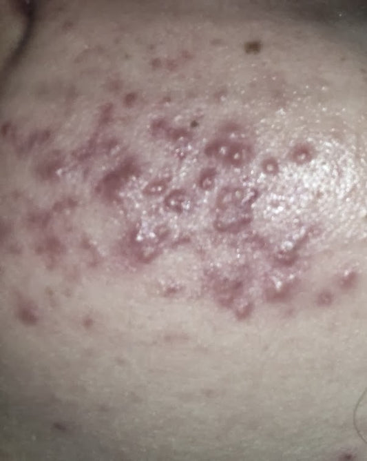 Beauty Myths No.6 - Having spots means you have an oily/combination skin