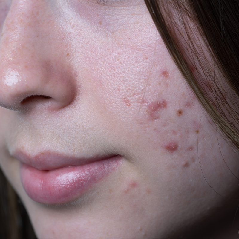 Breakouts on skin