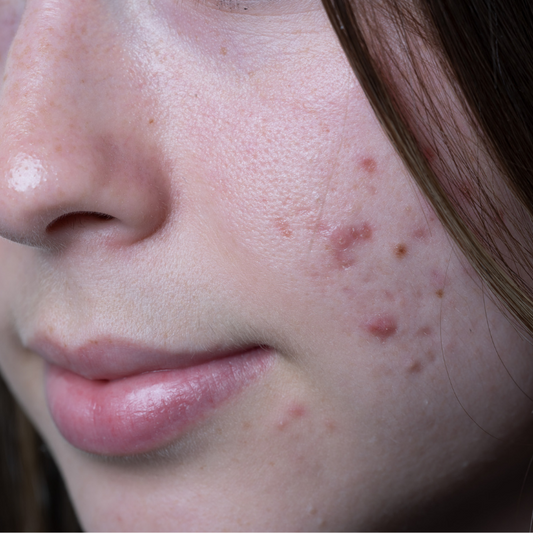 Breakouts on skin