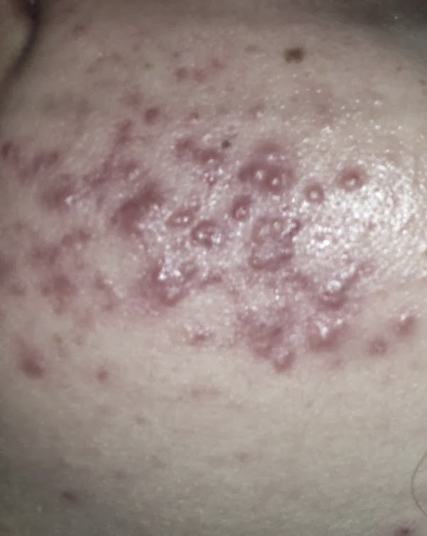 Beauty Myths No.6 - Having spots means you have an oily/combination skin